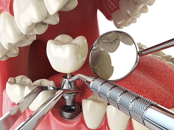Best Emergency Wisdom Teeth Removal in Harrah, OK